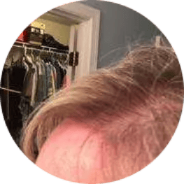 Hair loss close up